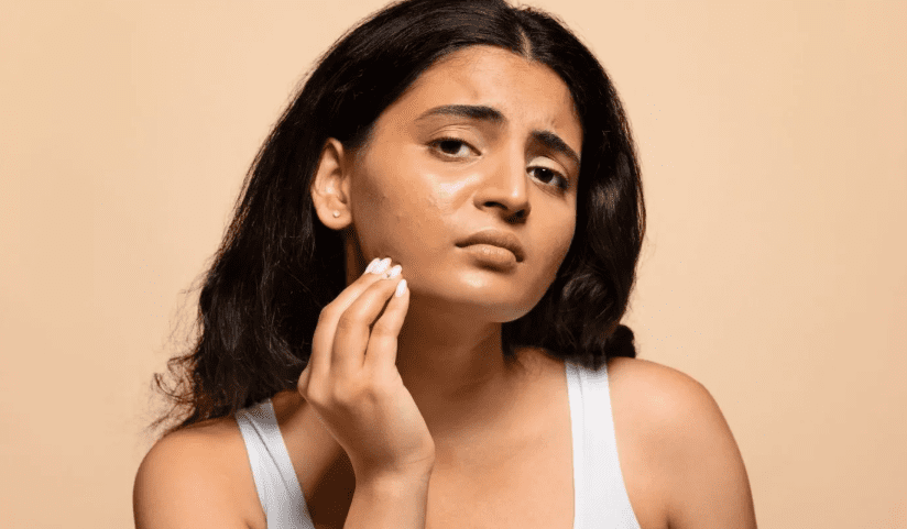 Best Acne Creams for Oily Skin: Expert-Recommended Picks That Actually Work